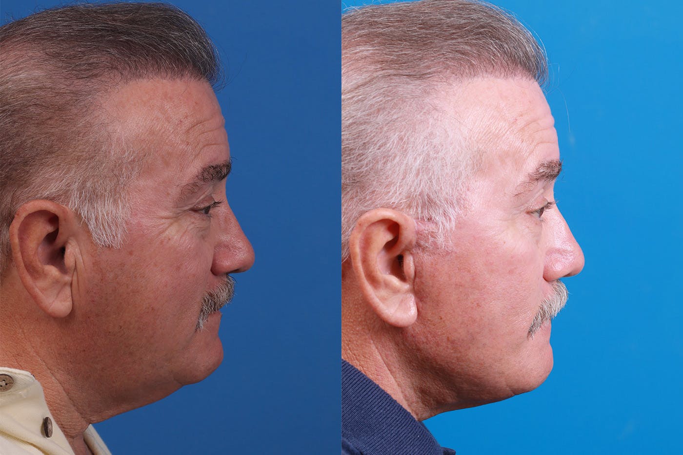 Facelift Before & After Gallery - Patient 150585031 - Image 3