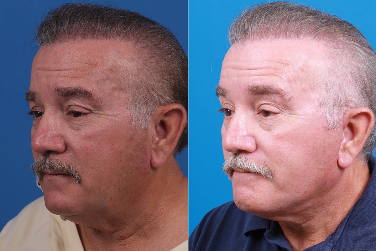 Facelift Before & After Gallery - Patient 150585031 - Image 4