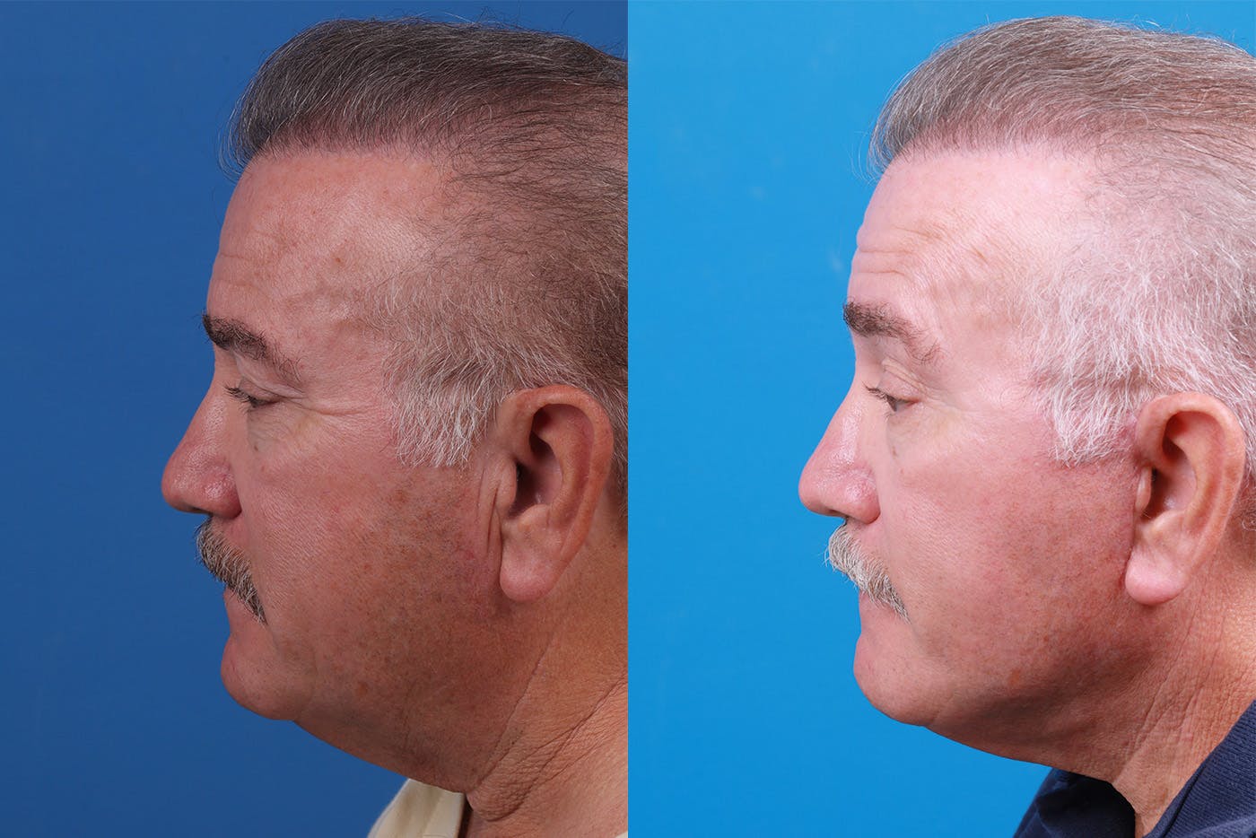 Facelift Before & After Gallery - Patient 150585031 - Image 5