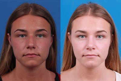 Rhinoplasty Before & After Gallery - Patient 154776513 - Image 1