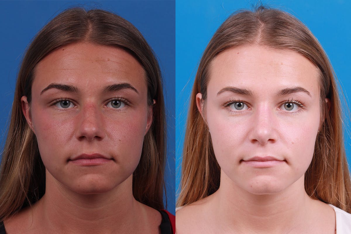Rhinoplasty Before & After Gallery - Patient 154776513 - Image 1
