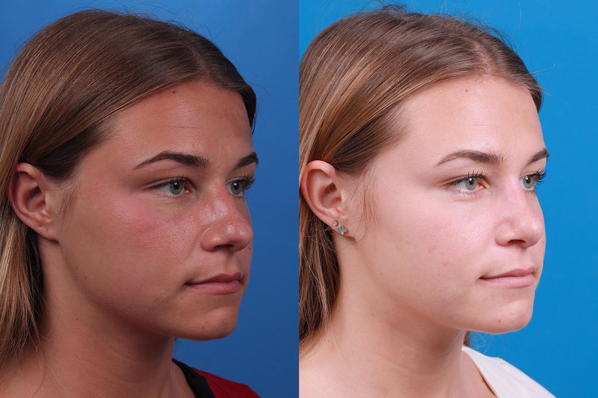 Rhinoplasty Before & After Gallery - Patient 154776513 - Image 2