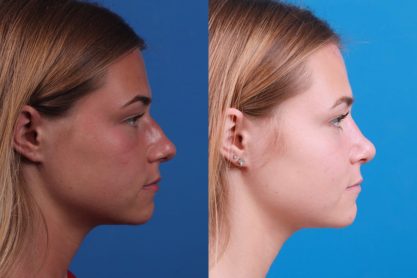 Rhinoplasty Before & After Gallery - Patient 154776513 - Image 3