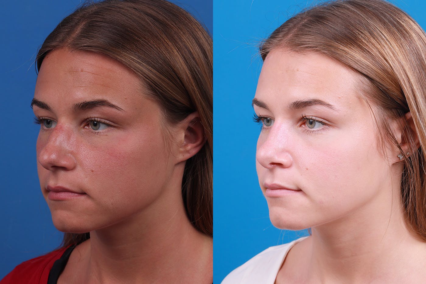 Rhinoplasty Before & After Gallery - Patient 154776513 - Image 4
