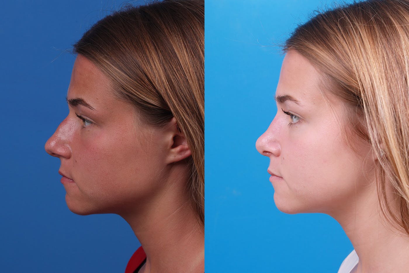 Rhinoplasty Before & After Gallery - Patient 154776513 - Image 5