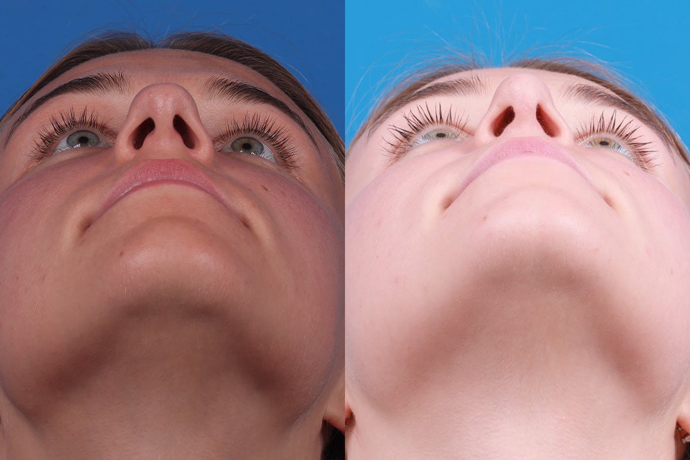 Rhinoplasty Before & After Gallery - Patient 154776513 - Image 6