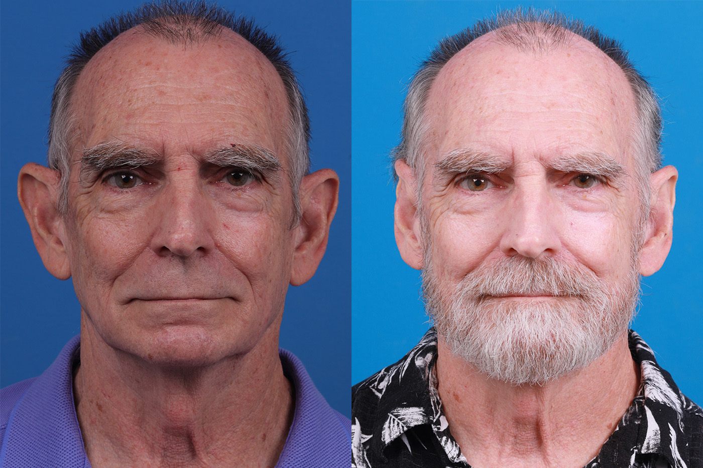 Ear Surgery Before & After Gallery - Patient 154776517 - Image 1