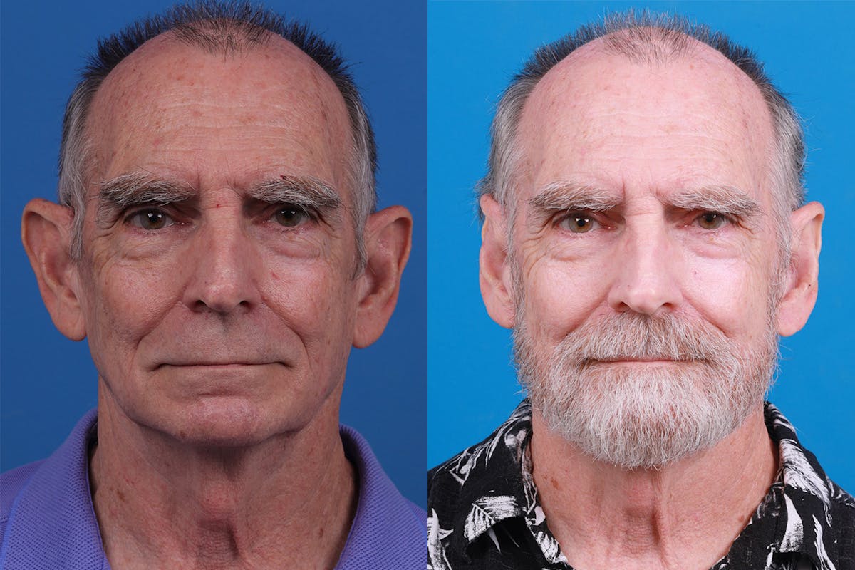 Ear Surgery Before & After Gallery - Patient 154776517 - Image 1