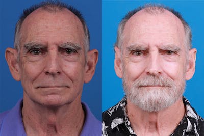 Ear Surgery Before & After Gallery - Patient 154776517 - Image 1