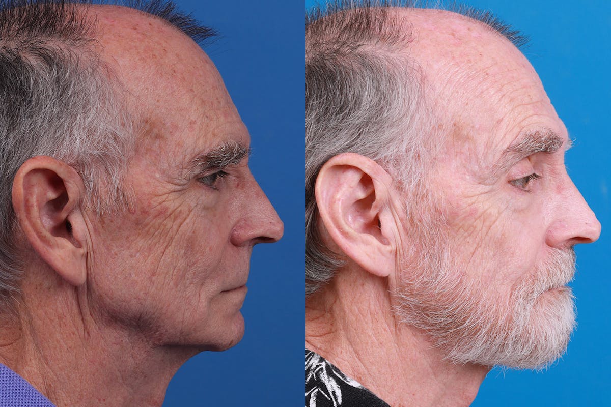 Ear Surgery Before & After Gallery - Patient 154776517 - Image 3