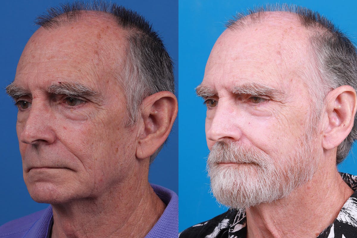 Ear Surgery Before & After Gallery - Patient 154776517 - Image 4