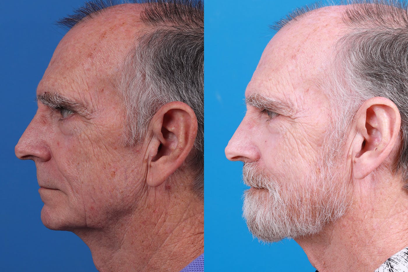 Ear Surgery Before & After Gallery - Patient 154776517 - Image 5