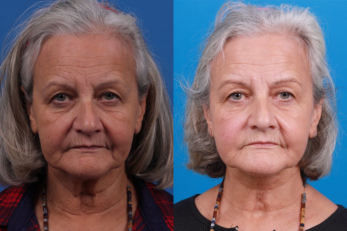 Profile Neck Lift Before & After Gallery - Patient 155012459 - Image 1
