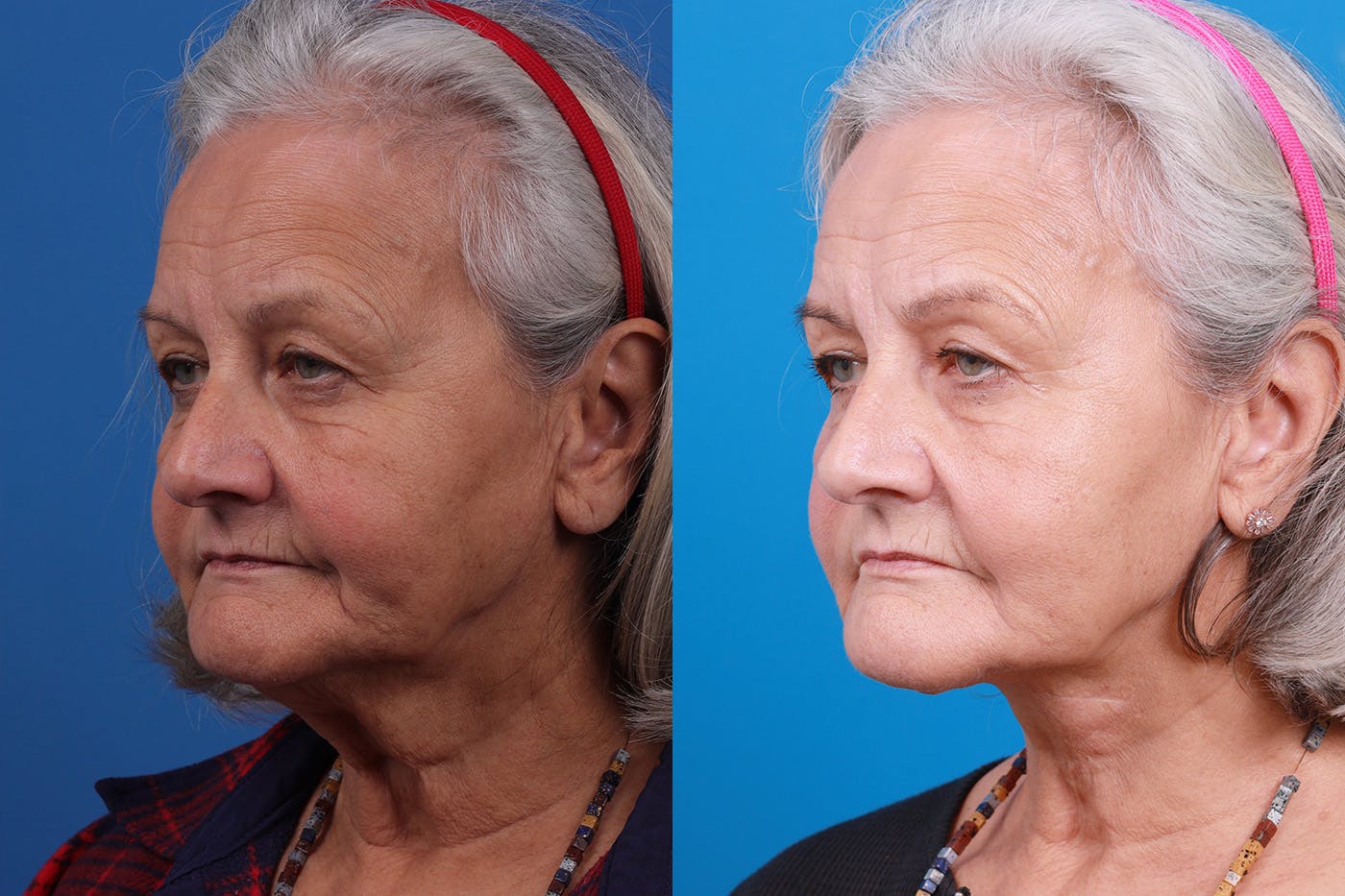 Profile Neck Lift Before & After Gallery - Patient 155012459 - Image 2