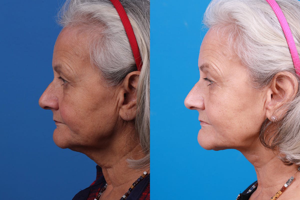 Profile Neck Lift Before & After Gallery - Patient 155012459 - Image 3