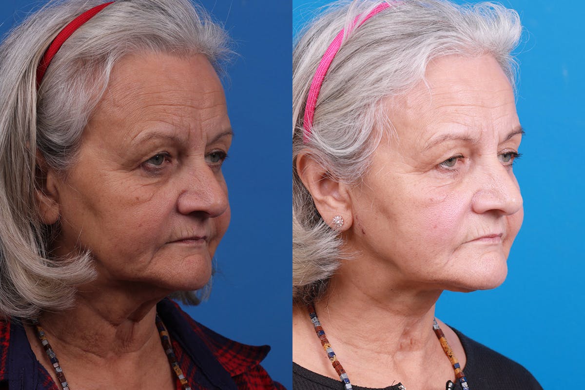 Profile Neck Lift Before & After Gallery - Patient 155012459 - Image 4
