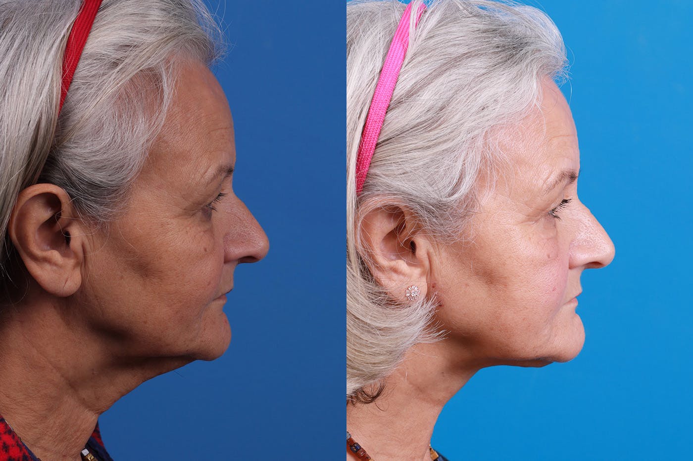 Profile Neck Lift Before & After Gallery - Patient 155012459 - Image 5