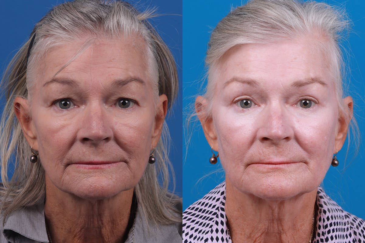 Skin Resurfacing Before & After Gallery - Patient 157104105 - Image 1