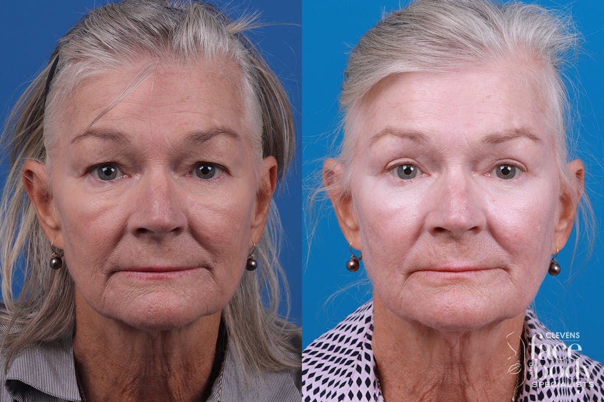 Skin Resurfacing Before & After Gallery - Patient 157104105 - Image 1