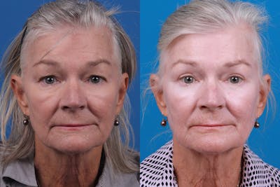 Skin Resurfacing Before & After Gallery - Patient 157104105 - Image 1