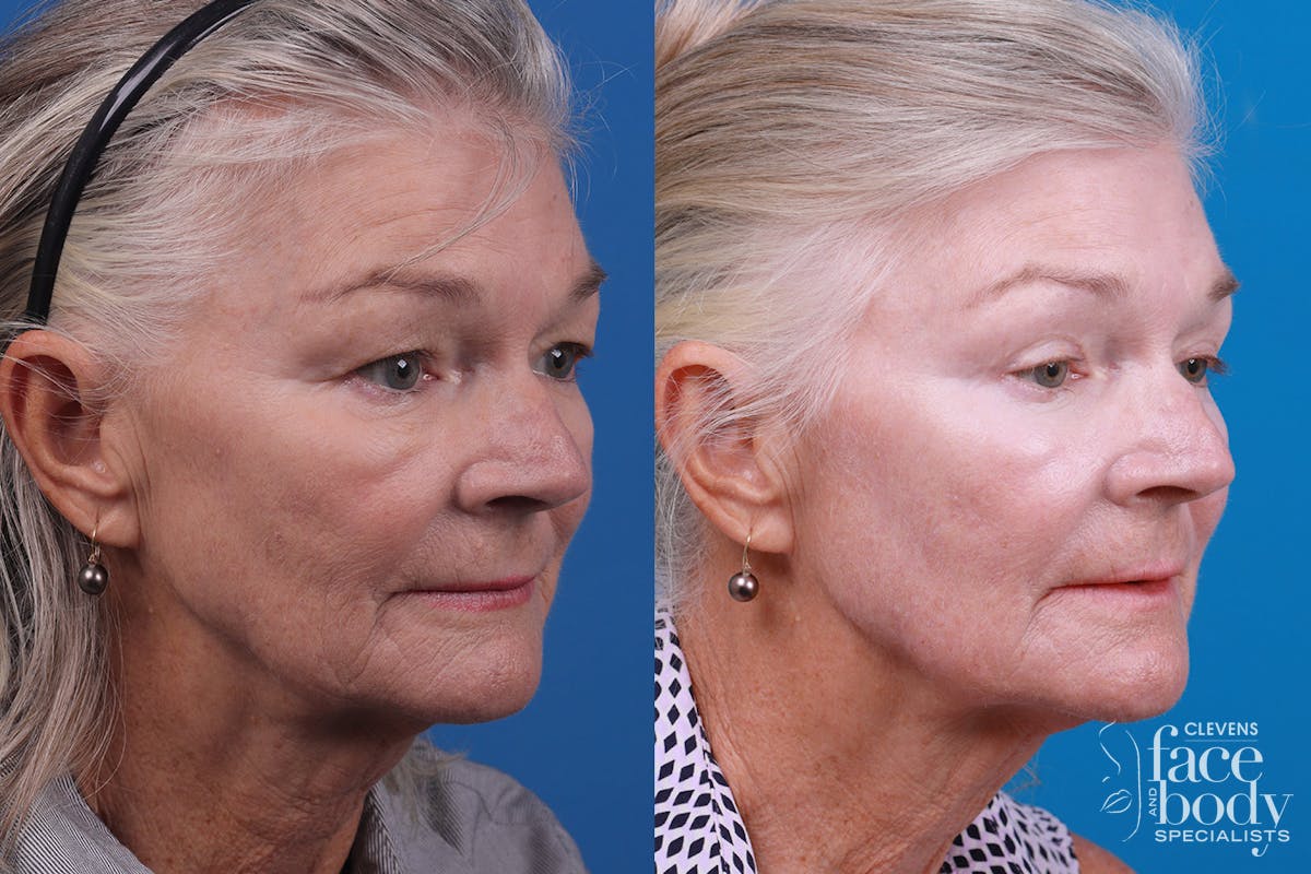 Skin Resurfacing Before & After Gallery - Patient 157104105 - Image 2