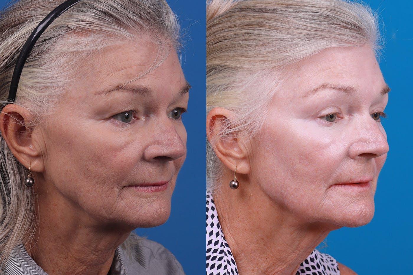 Skin Resurfacing Before & After Gallery - Patient 157104105 - Image 2