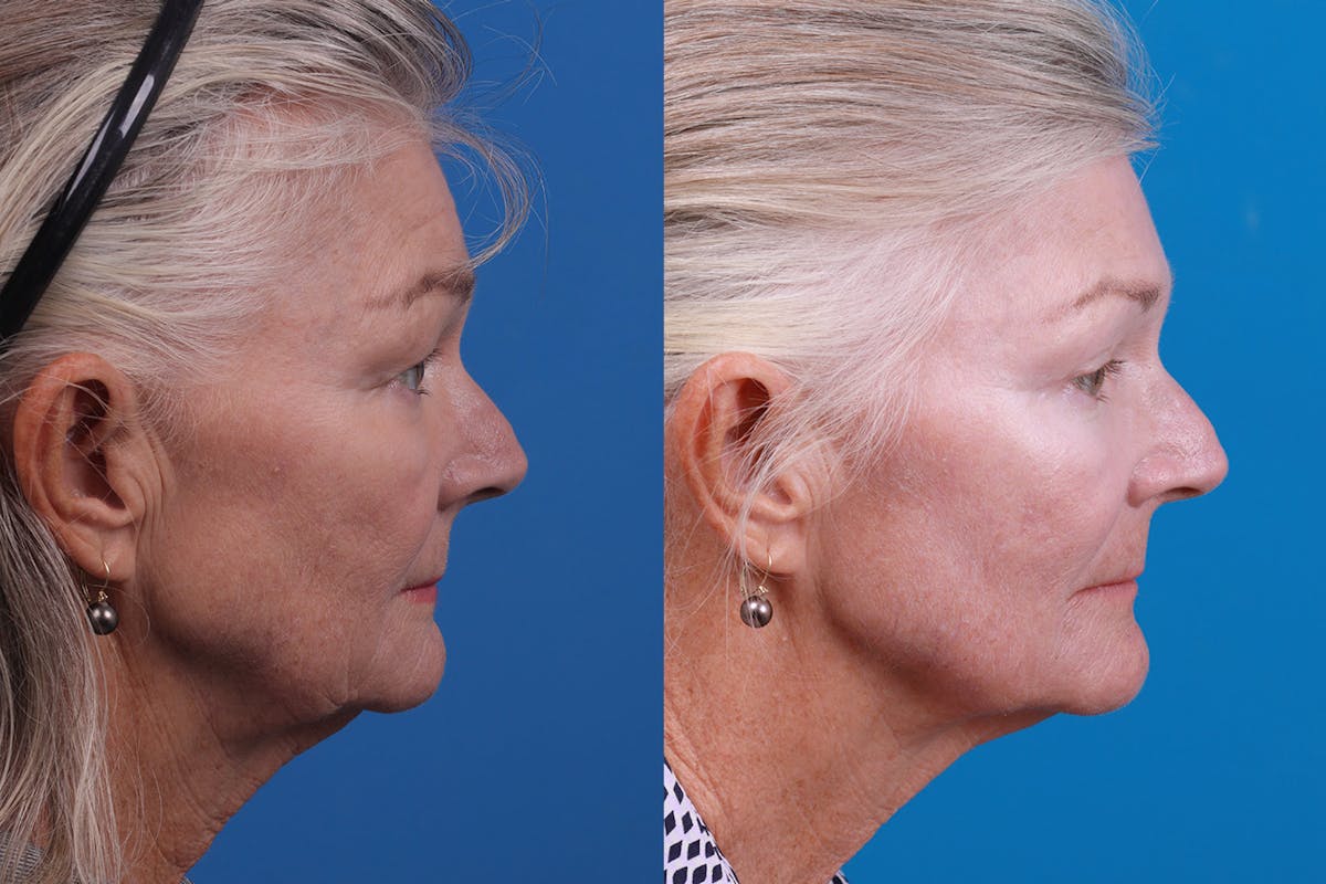 Skin Resurfacing Before & After Gallery - Patient 157104105 - Image 3