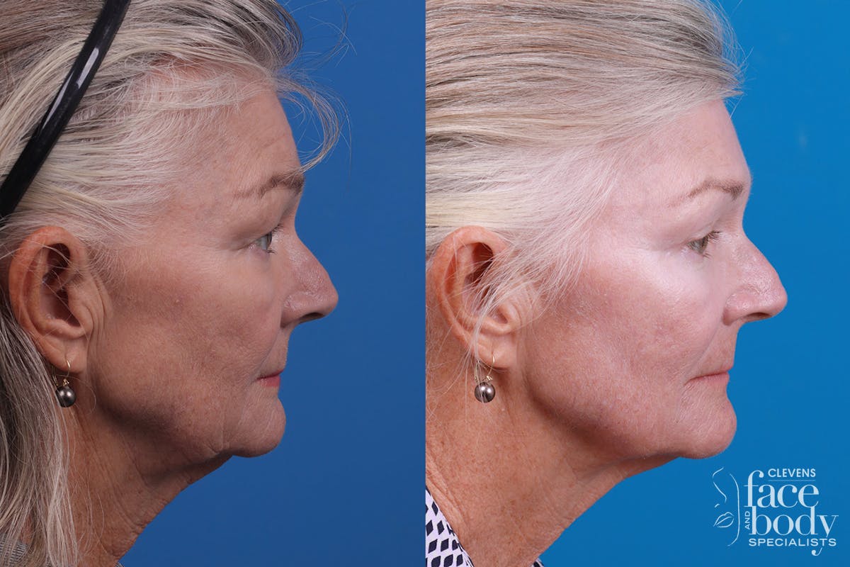 Skin Resurfacing Before & After Gallery - Patient 157104105 - Image 3