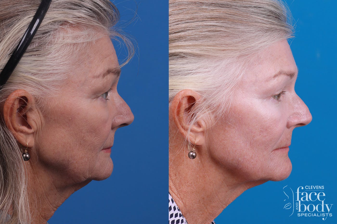 Skin Resurfacing Before & After Gallery - Patient 157104105 - Image 3