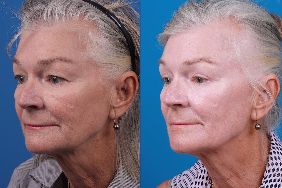 Skin Resurfacing Before & After Gallery - Patient 157104105 - Image 4