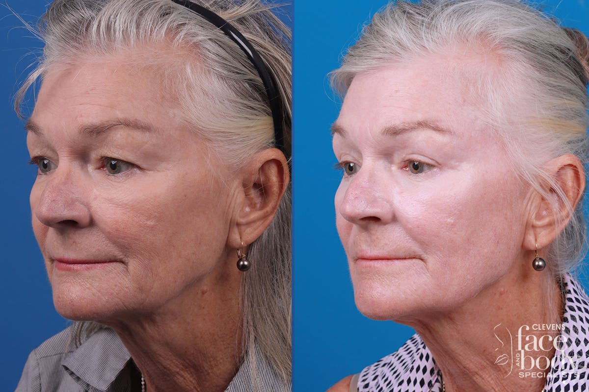 Skin Resurfacing Before & After Gallery - Patient 157104105 - Image 4
