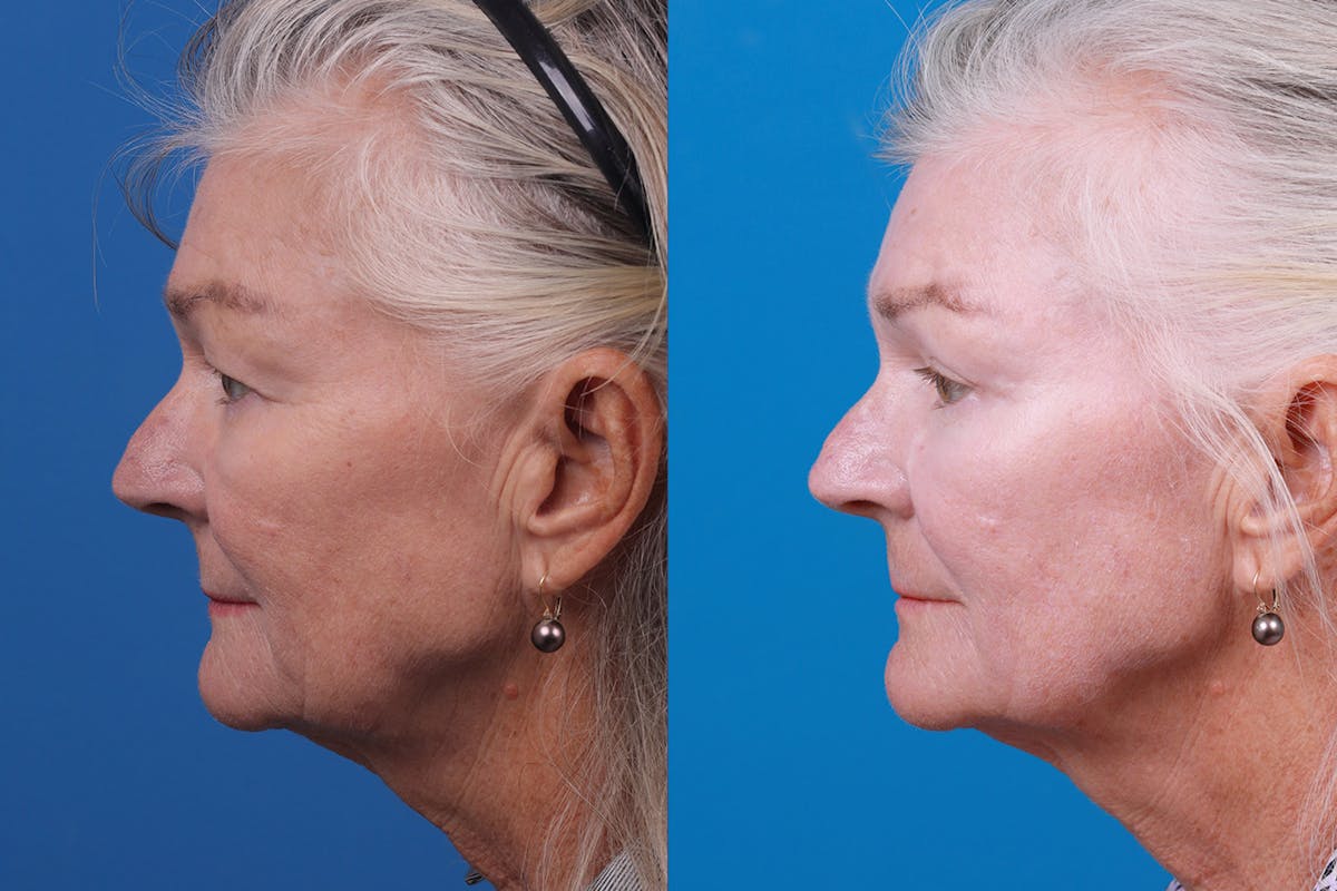 Skin Resurfacing Before & After Gallery - Patient 157104105 - Image 5