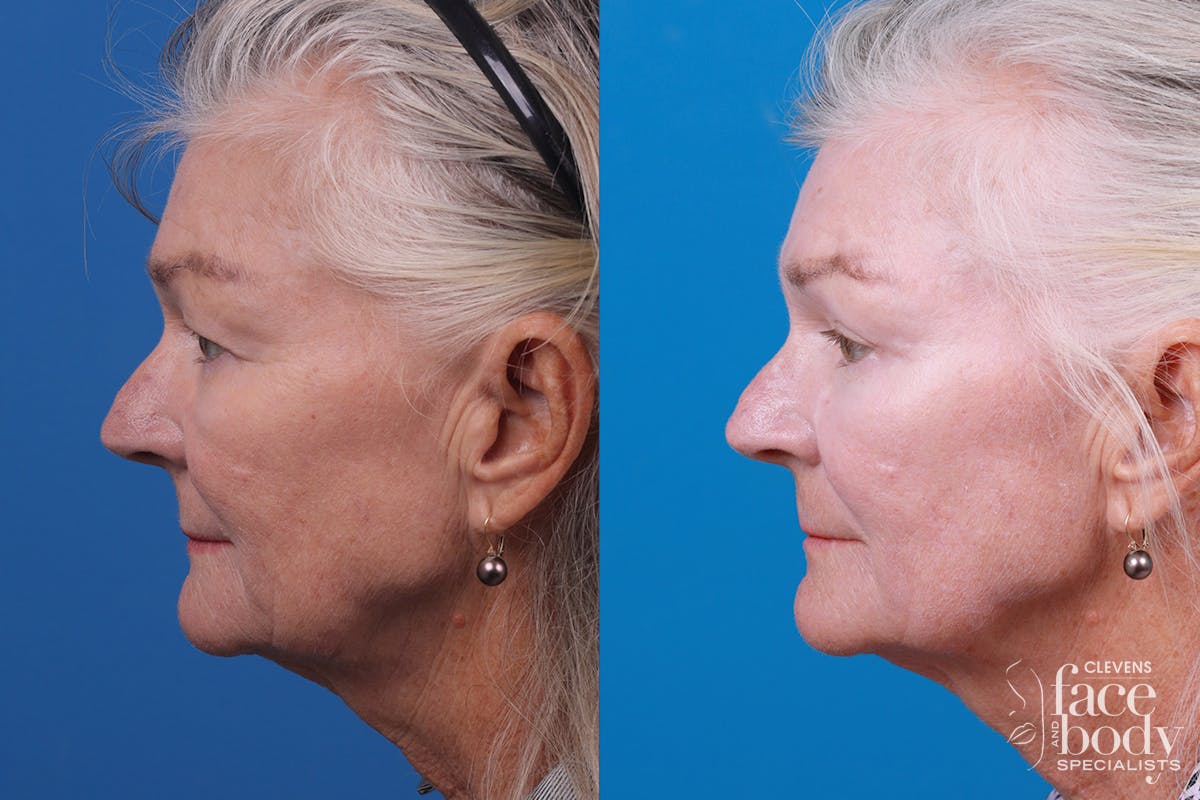 Skin Resurfacing Before & After Gallery - Patient 157104105 - Image 5