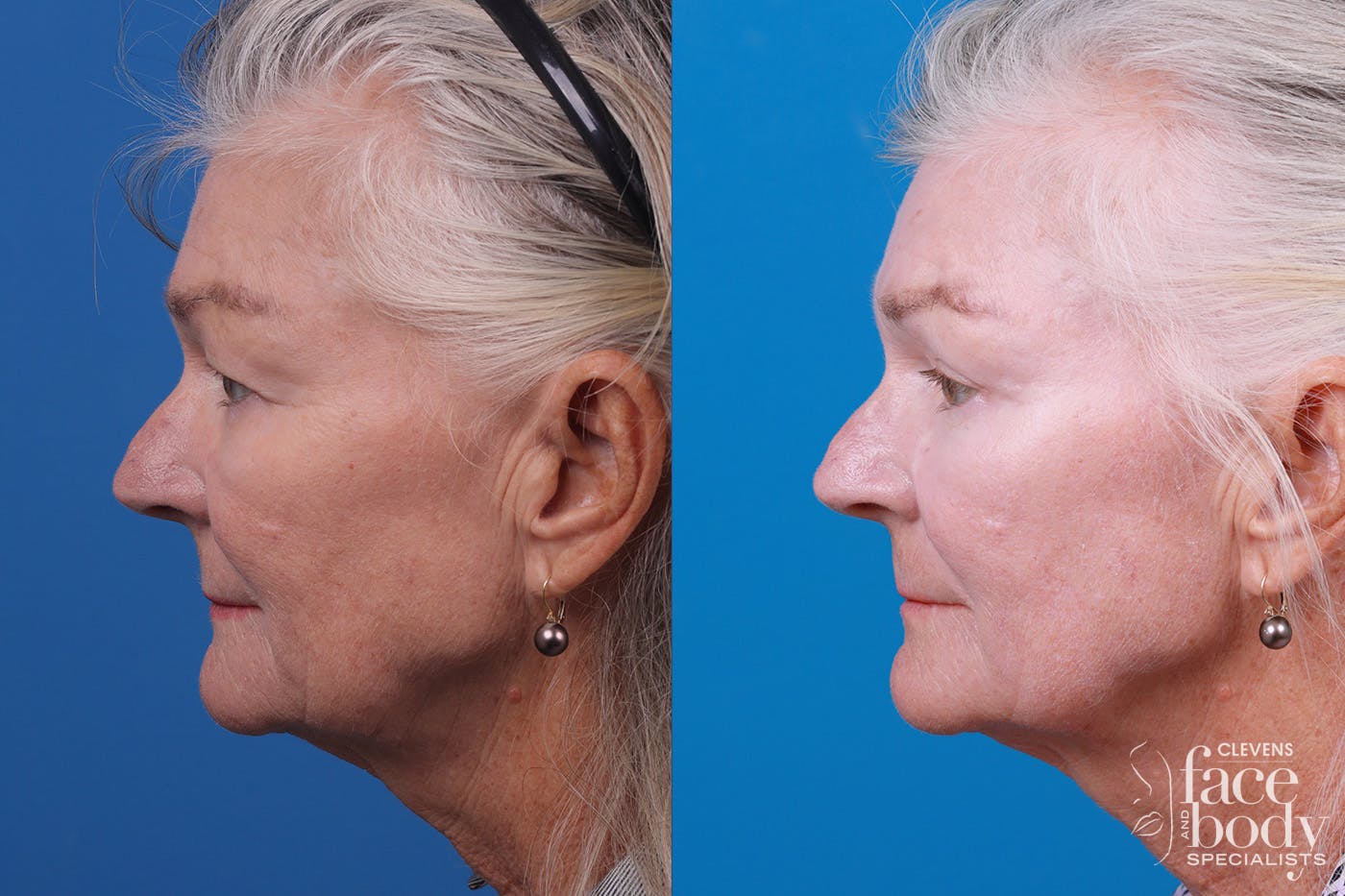 Skin Resurfacing Before & After Gallery - Patient 157104105 - Image 5