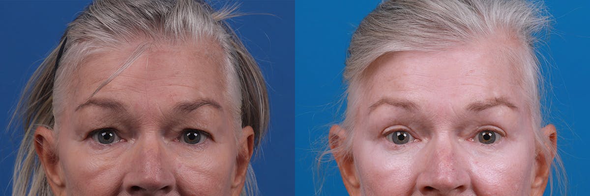 Eyelid Surgery Before & After Gallery - Patient 157104110 - Image 1