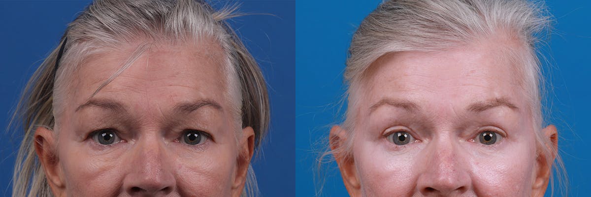 Eyelid Surgery Before & After Gallery - Patient 157104110 - Image 1