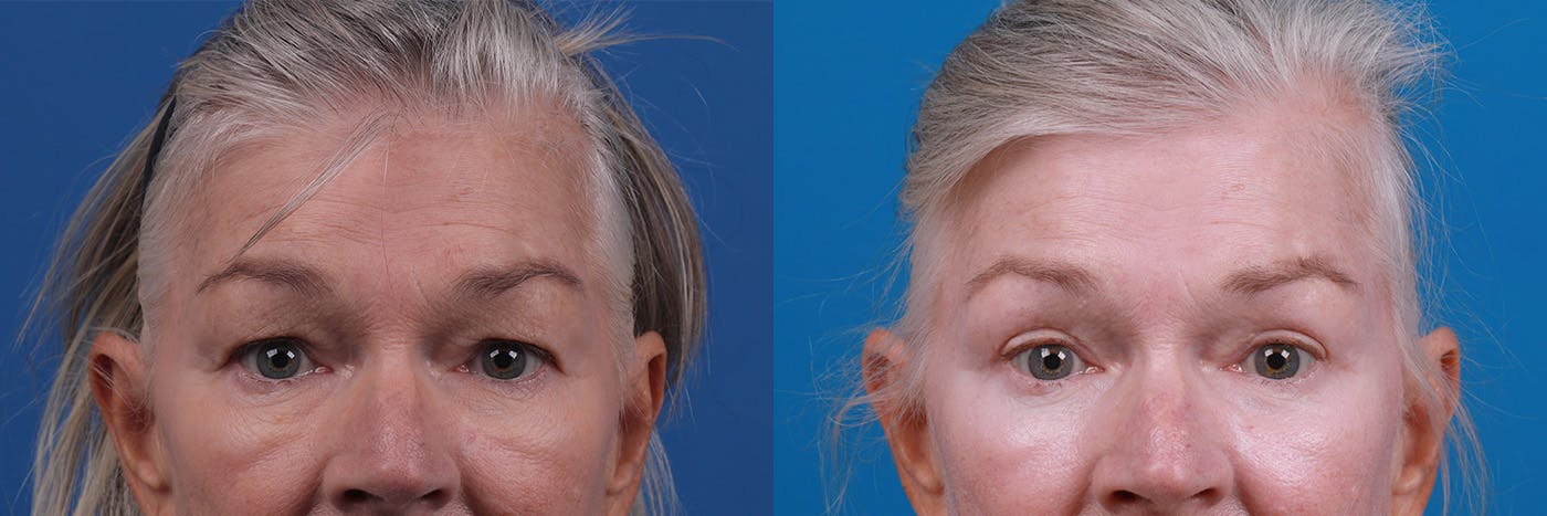Eyelid Surgery Before & After Gallery - Patient 157104110 - Image 1