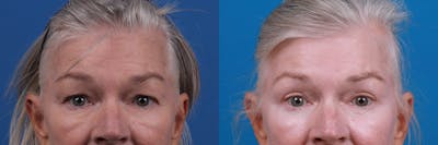 Eyelid Surgery Before & After Gallery - Patient 157104110 - Image 1