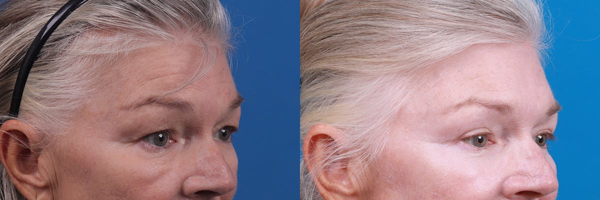 Eyelid Surgery Before & After Gallery - Patient 157104110 - Image 2