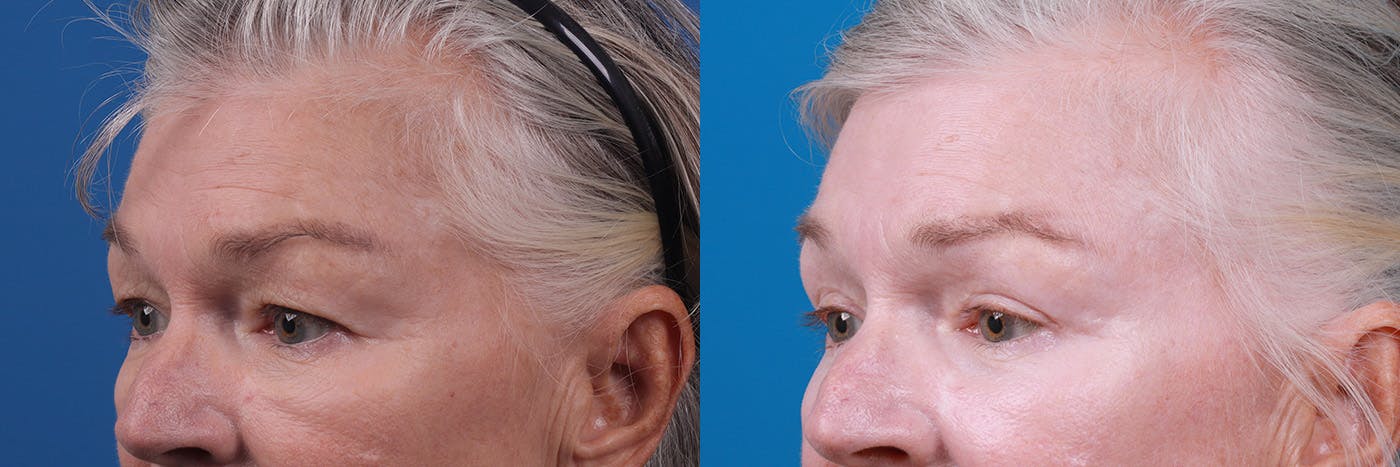 Eyelid Surgery Before & After Gallery - Patient 157104110 - Image 3