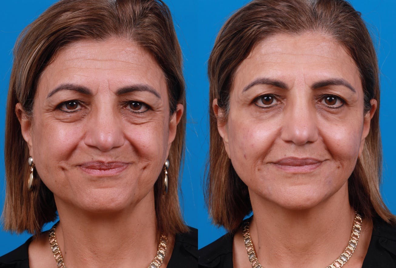 Dermal Fillers Before & After Gallery - Patient 157171634 - Image 1