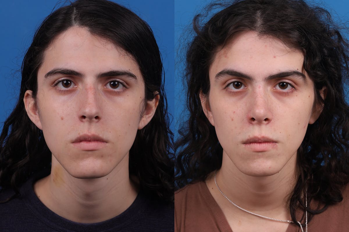 Rhinoplasty Before & After Gallery - Patient 157603021 - Image 1