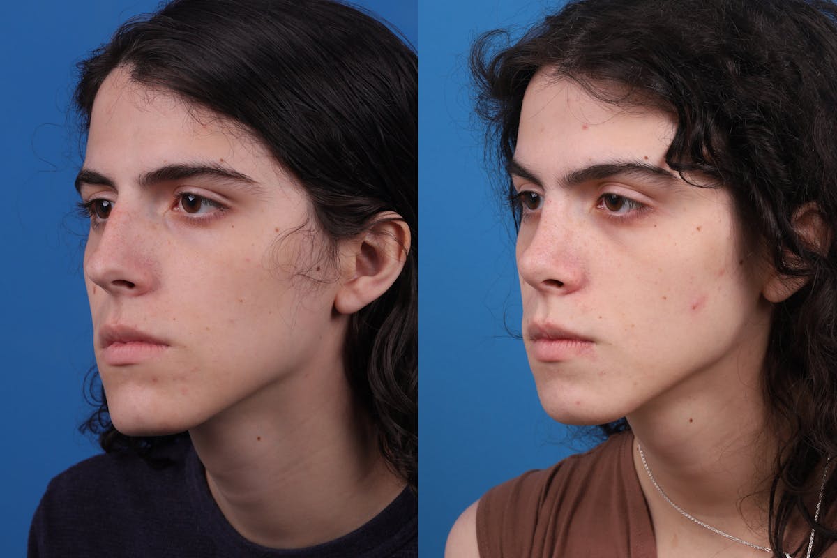 Rhinoplasty Before & After Gallery - Patient 157603021 - Image 2