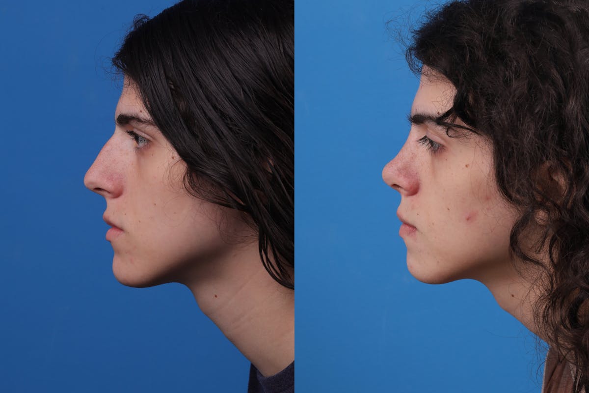 Rhinoplasty Before & After Gallery - Patient 157603021 - Image 3