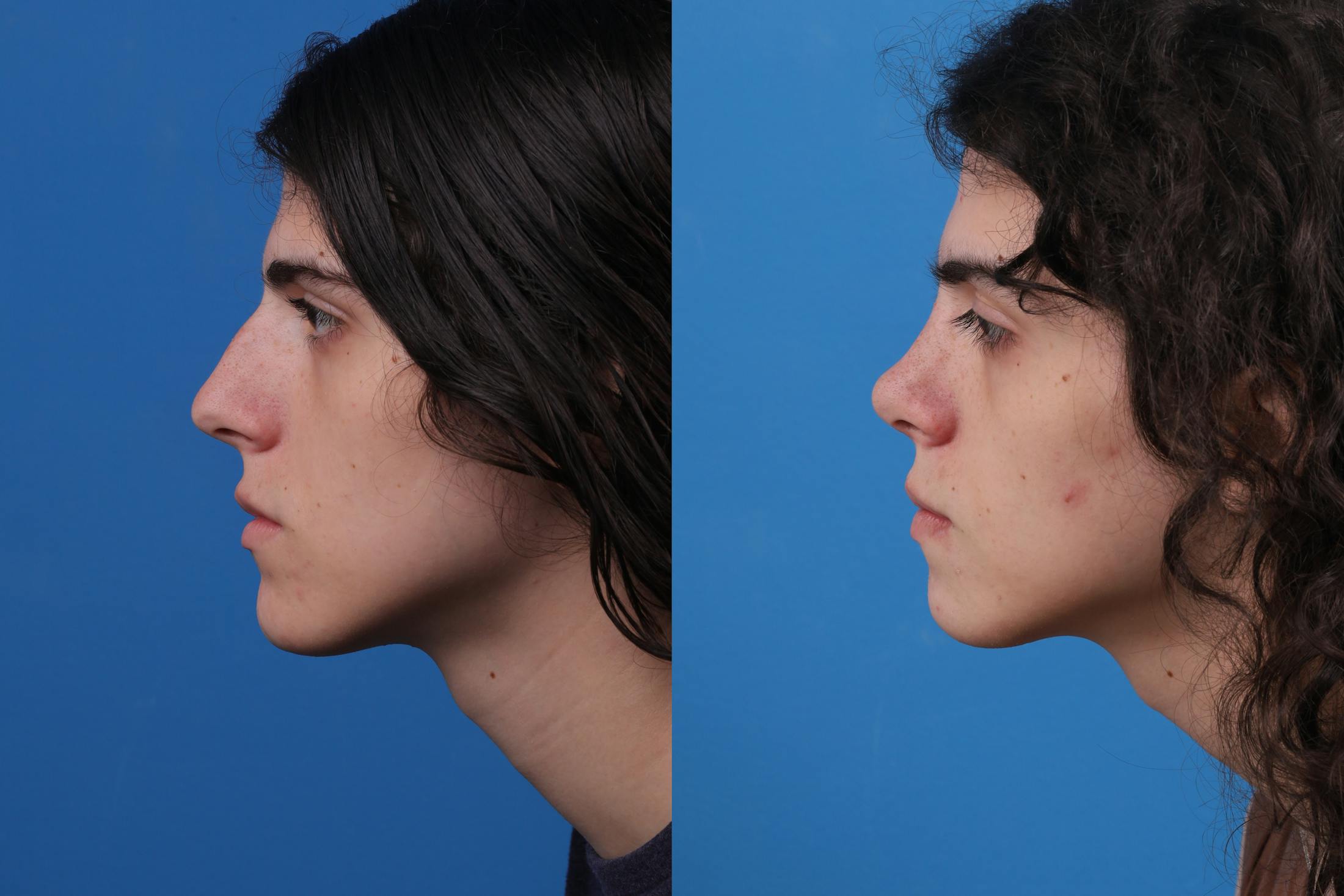 Rhinoplasty Before & After Gallery - Patient 157603021 - Image 3