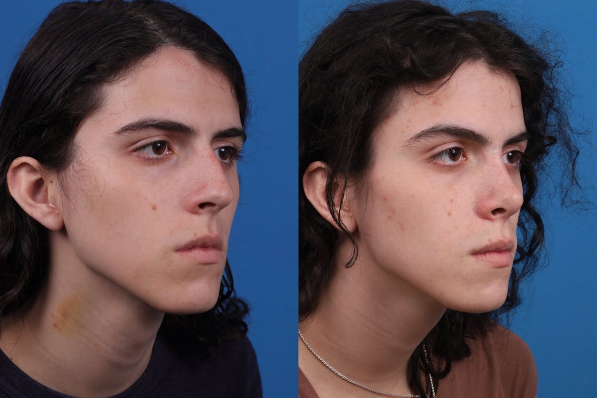 Rhinoplasty Before & After Gallery - Patient 157603021 - Image 4
