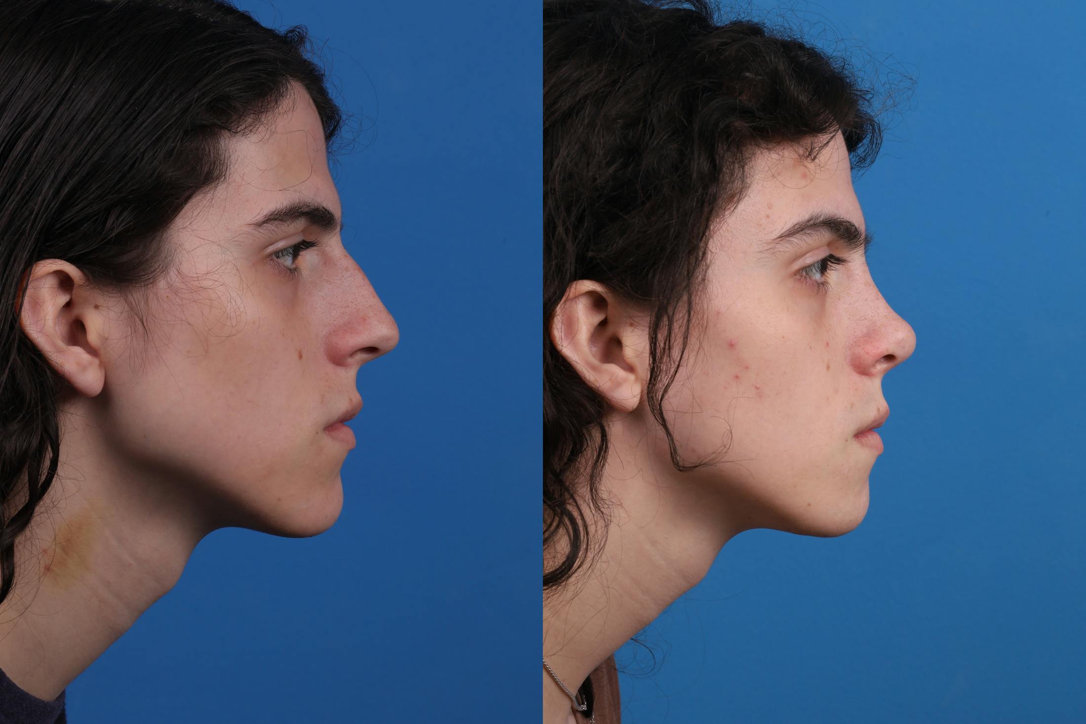 Rhinoplasty Before & After Gallery - Patient 157603021 - Image 5