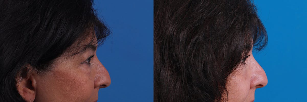 Eyelid Surgery Before & After Gallery - Patient 159002427 - Image 4