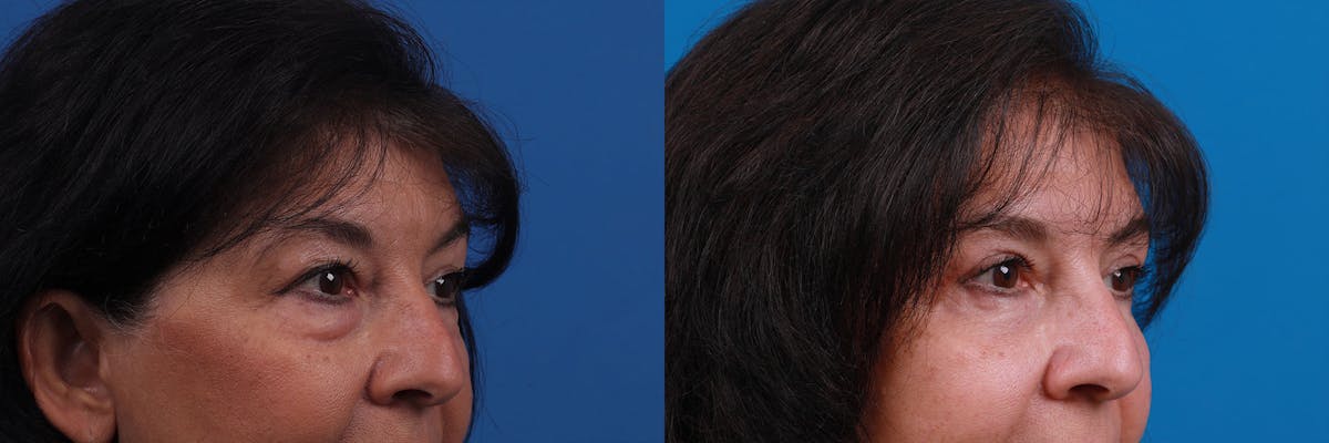Eyelid Surgery Before & After Gallery - Patient 159002427 - Image 5
