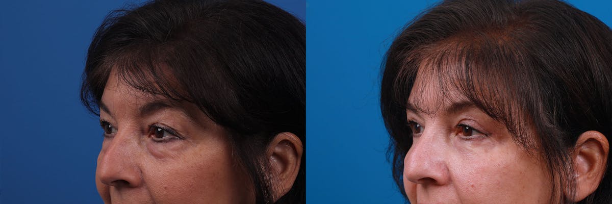 Eyelid Surgery Before & After Gallery - Patient 159002427 - Image 2